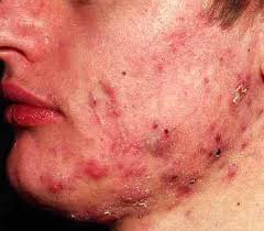 Acne e espinhas podem ser um problema