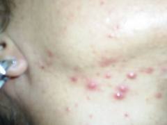 Imagem de Acne Grau 2