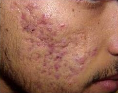 Imagem de Acne Grau 3