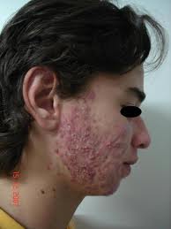 Imagem de Acne Grau 4