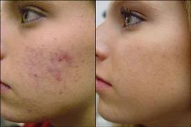 Acne tratamento