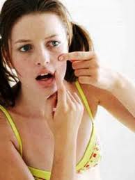 Acne vulgar é uma doença de pele que causa cravos e espinhas Acne vulgar é uma doença de pele que causa cravos e espinhas