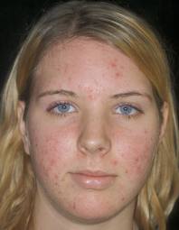 Foto de uma adolescente com acne, cravos e espinhas. Foto de uma adolescente com acne, cravos e espinhas.