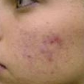 Tudo sobre a Acne vulgar