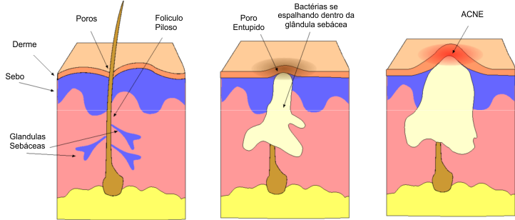 Como surgem as espinhas e quais as causas da acne.