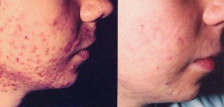 Acne antes e depois do tratamento com isotretinoína. Acne antes e depois do tratamento com isotretinoína.
