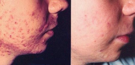 Acne antes e depois do tratamento com isotretinona.