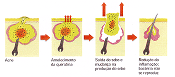 Isotretinona  um remdio que serve para o tratamento de acne e espinhas.