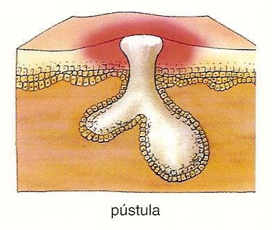 O que  a acne, a espinha ou pstula.