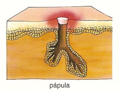 Descubra o que  a acne e como  uma papula.